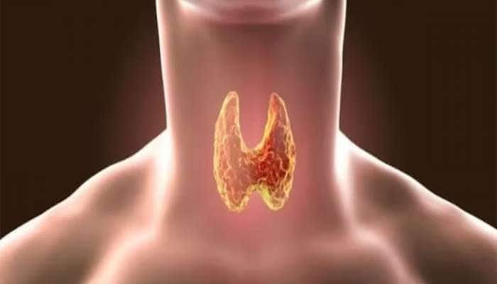 થાઈરોઈડથી છુટકારો મેળવવાનો આયુર્વેદિક ઈલાજ, થોડા જ દિવસોમાં દેખાશે અસર