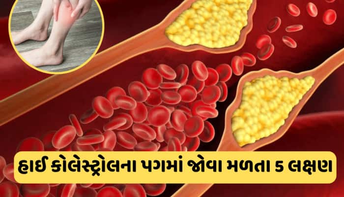 કોલેસ્ટ્રોલ વધવા લાગે તે પહેલા પગમાં જોવા મળે છે આ 5 લક્ષણ, ભૂલેચૂકે નજરઅંદાજ ન કરતા