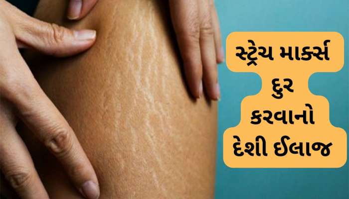 સાથળ પરના સ્ટ્રેચ માર્ક્સ દુર કરવાનો દેશી ઈલાજ, આ વસ્તુ રોજ લગાડવાથી નિશાન દુર થશે