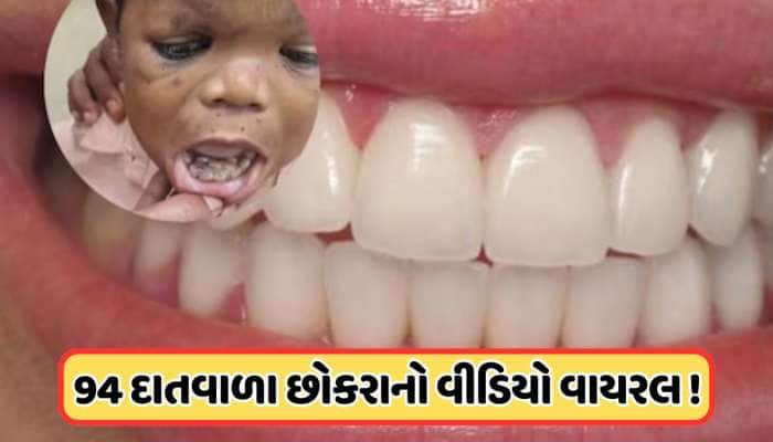 આઠમી અજાયબી! 32 નહીં આ છોકરાના મોઢામાં છે પુરા 94 દાંત, જુઓ વાયરલ વીડિયો