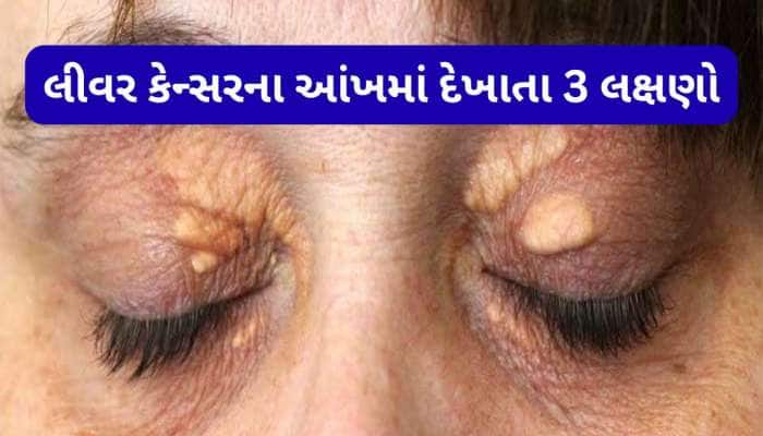 લીવર કેન્સરના કારણે આંખમાં થાય છે આ 3 ફેરફાર, આંખમાં દેખાતા આ લક્ષણને ઈગ્નોર ન કરવા